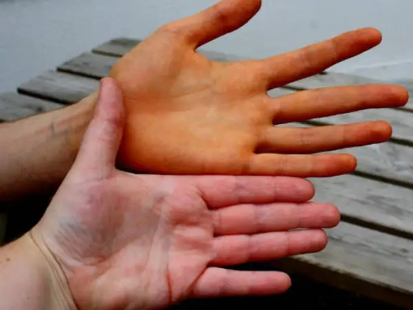 Zwei Hände im Vergleich: Eine ist orange gefärbt, was auf die carotin wirkung hindeutet. Die andere Hand hat eine normale Hautfarbe.